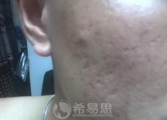 痘坑能改善到什么程度？小羊的真實經歷告訴你答案