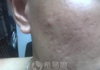 痘坑能改善到什么程度？小羊的真實經歷告訴你答案